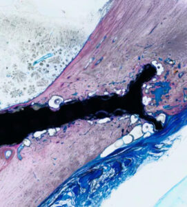 Activa | Natural Healing with Absorbable Orthopedic Implants